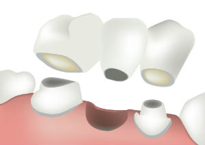 Dental Bridges | Sunstar Dental Care | Dentist La Puente, CA