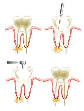 Root Canals | Sunstar Dental Care | Dentist La Puente, CA