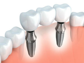 Dental Implants | Sunstar Dental Care | Dentist La Puente, CA